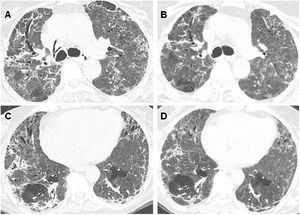 Patient with COVID-19, who was admitted to the ICU and needed mechanical ventilation. (A and C) Chest CT four months after the onset of symptoms demonstrates diffuse ground-glass and reticular opacities, consolidations, and bilateral peripheral bronchiectasis and bronchiolectasis. (B and D) At 7-month follow-up, chest CT shows partial improvement of the lesions.
