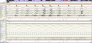 A 30-second epoch of PSG-C (EEG (F4-M1, C4-M1, O2-M1), EOG (E1-M1, E2-M1), EMG and electrocardiogram) showing (arrows) the cyclical contractions in the chin EMG visible in the EEG/EOG derivations. The contractions coincide with the inspiration.