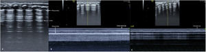 Normal lung ultrasound manifestations. The healthy lung shows a bamboo sign on B-mode ultrasound (A) and a seashore sign (B) on M-mode ultrasound. If the lung sliding disappears on real-time ultrasound, the series of horizontal parallel lines can be seen on M-mode ultrasound; this is the so-called stratosphere sign, which is the specific sign of PTX on M-mode ultrasound (C).