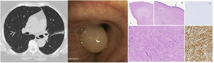 Computed tomography thorax (a), bronchoscopic image (b) of endobronchial leiomyoma at left main bronchus and anatomical-pathological image (c: A. Bronchial biopsy showing a well-circumscribed lesion with polypoid appearance. Hematoxylin–eosin (H&E) staining 1×. B. Cellular proliferation lined by bronchial epithelium (black arrow). H&E 4×. C. At higher power view there