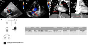 Panel A. Incidental atrial septal defect detected in TTE, showing right-to-left shunting (red arrow); Panel B. Small perimembranous ventricular septal defect (VSD) with Left-to-right shunting during systole (red arrow); Panels C and D. Reconstruction of some of the thoracic collaterals noticed in the mediastinum in the angiographic computed tomography (red arrows); Panel E. Genetic analysis and segregation study of first-degree relatives.