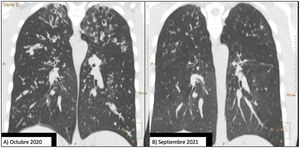 Comparison of 2 coronal chest CT reconstructions. Image (A) shows extensive bilateral bronchiectasis, with significant thickening of the bronchial walls, mucus plugging, and a tree-in-bud pattern. After 1 year of treatment with elaxacaftor/tezacaftor/ivacaftor, image (B), bronchiectasis is significantly reduced and practically resolved.