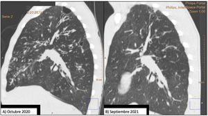 Comparison of 2 sagittal chest CT reconstructions. Image (A) shows a thin-walled cystic lesion (bulla), extensive bilateral bronchiectasis, with significant thickening of the bronchial walls and a tree-in-bud pattern. After 1 year of treatment with elaxacaftor/tezacaftor/ivacaftor, image (B), bronchiectasis is significantly improved and the apical bulla is resolved.