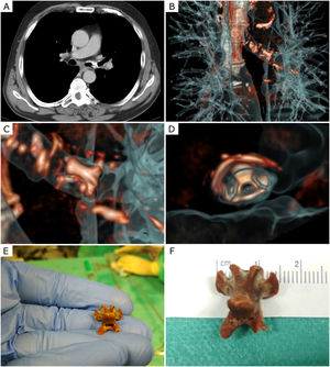 (A) Chest CT (axial plan): a perforated foreign body in the left main bronchus; (B) 3D CT reconstruction showing the bronchial tree and a perforated foreign body in the left main bronchus; (C) 3D CT reconstruction showing a perforated foreign body in the left main bronchus; (D) 3D CT reconstruction showing a perforated foreign body in the left main bronchus; (E) Foreign body compatible to a chicken's vertebra; (F) Foreign body compatible to a chicken's vertebra, measuring 1.5cm×1.5cm.