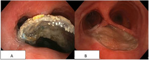 Esophageal stent emerging above the main carina after rupture of the pars membranacea of the trachea (A); well-positioned radial myocutaneous flap with closed fistula. Hairs can be seen on its surface (B).