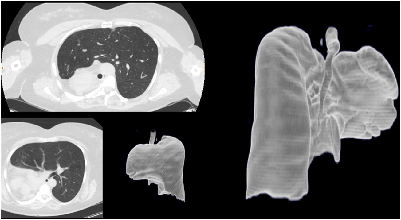 A Silent Pulmonary Agenesis | Archivos de Bronconeumología