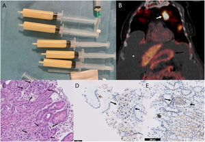 (A) Milky pleural effusion consistent with chylothorax. (B) Coronal PET/CT image, revealing increased metabolism in the pulmonary nodule of the left upper lobe (white arrow), moderate–severe ascites (asterisk), and lack of increased metabolism at the gastric level (black arrow). (C) Gastric fundus biopsy (40×, hematoxylin–eosin), showing intact oxyntic gastric mucosa. At higher magnifications, small tumor cell groups are observed, predominantly within the capillaries, with distorted glandular architecture and atypical cells with enlarged nuclei of irregular size. (D) Immunohistochemistry for TTF1 (40×), showing nuclear positivity in tumor cell clusters, consistent with pulmonary origin. (E) Immunohistochemistry for CDX2 (40×), a marker of gastrointestinal differentiation, which is negative in the tumor cell clusters.