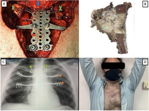 (A) Sternal reconstruction with Trionyx Rib Fixation System® and sternoclavicular joint fixation with wedge anchor (Stryker®) (green cross: clavicles; blue cross: sternocleidomastoid muscle attached to titanium sternal plate). (B) Gross specimen of the manubrium shows tumor growth. (C) The post-operative chest X-ray shows the costal arches fixations (orange arrows) and the 3 wedge anchors in both clavicles (green arrows). (D) Outcomes at the first postoperative month: position with arms in abduction without functional limitation.