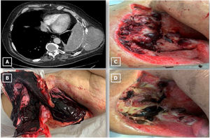 (A) Chest computed axial tomography showed encapsulated pleural effusion, pleural calcification and heterogeneous soft tissue mass (85mm×110mm) destroying the 9th and 10th ribs. (B) Clots after thoracostomy bleeding. (C) Friable protruding lesions in thoracostomy. (D) Protuding lesions after radiotherapy and chemotherapy treatment.
