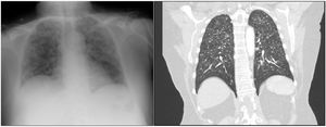 Chest X-ray (left) and coronal section of CT (right) image showing randomly distributed pulmonary micronodules in both fields.