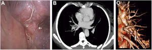 A. Thoracoscopic intraoperative findings. B. Preoperative CT-scan. C. CT-scan tridimensional reconstruction.