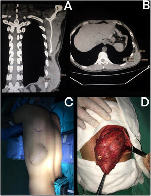 (A-B) pre-surgical CT scan, (C) surgical position, (D) surgical specimen.