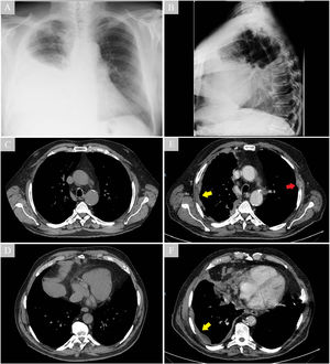 The images show the evolution of the radiological findings over six months. CT scan performed six months prior to admission, with no findings (C and D). Chest X-ray with a right pleural effusion performed when the patient consulted the emergency department (A and B). Diffuse right pleural thickening (yellow arrows) and lytic lesion in the left fourth costal arch (red arrow) after drainage of the pleural effusion (E and F).