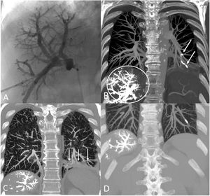 (A) Digital subtraction angiogram shows the right portal vein embolization procedure using cyanoacrylate-lipiodol. (B) Coronal thoracic maximum intensity projection (MIP) CT image performed 24h after the combined portal and hepatic veins embolization (circle) shows the migration of cyanoacrylate-lipiodol to subsegmental left lower lobe arteries (arrows). (C) Coronal thoracic MIP CT image (lung window) shows a partial consolidation of the left lower lobe (arrows). (D) Coronal upper abdominal MIP CT image (lung window) performed 2 weeks later shows resolution of the left lower lobe consolidation.