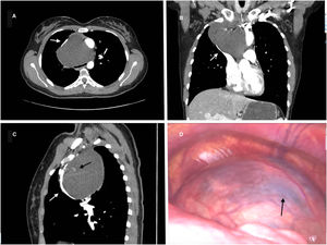 (A–C) Thoracic CT in axial, coronal and sagittal planes respectively: Hypodense lesion located in the middle mediastinum presenting dimensions of 8.9cm×9.7cm×10.8cm in the three axes of cystic appearance. It compresses and displaces the superior vena cava without infiltration (white arrow). Medially it contacts the aortic arch. Subsequently compresses and obliterates the tracheal lumen without signs of infiltration. There are areas of increased density compatible with intracystic hemorrhage (black arrow). (D) VATS: Mediastinal lesion of cystic appearance. The dark content (hematoserosus) is observed in its interior due to the thinness of its wall in some areas (black arrow).