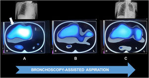 Images obtained by electrical impedance tomography before bronchoscopy-assisted tracheobronchial aspiration was initiated (A), during the procedure (B), and immediately after its conclusion (C). At the start of the procedure, a clear unilateral distribution of ventilation is present (white arrow). The blue–white gradient indicates regional distribution of tidal ventilation. In the upper part chest X-rays carried out before and immediately after the procedure are shown (L=left; R=right).