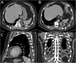 Contrast-enhanced portal venous phase CT scan. (A and B) Axial views. Right and left pleural effusion and pleural appendages (arrows). (C) Sagittal view. Left pleural effusion and a pleural appendage (arrow). (D) Coronal view. Multiple bilateral pleural appendages floating in pleural effusion (*).