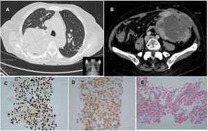 (A) Thoracic scan showing a pulmonary mass in the right upper lobe, measuring 90mm×87mm. (B) Abdominal and pelvic CT scan showing a mass on the left flank with 103mm×83mm. (C and D) The tumor cells express both TTF-1 and cytokeratin 7, which is compatible with pulmonary origin. (E) H&E staining: poorly differentiated adenocarcinoma.