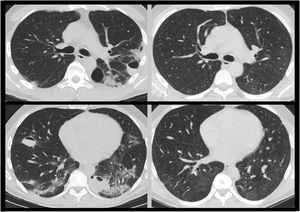 Thoracic CT images observing bilateral bullous injuries and their comparison at the same level in a CT control showing their resolution after 3 months.