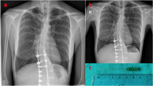 (a) Posteroanterior chest radiograph showing grade I pneumothorax in the right lung apex. (b) Follow-up chest radiograph showing complete resolution of the pneumothorax 10 days later. (c) EMG needle used in the examination of the serratus anterior muscle.