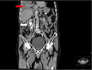 Right pleural effusion (red arrow), contrast extravasation related to rupture of both ureters and formation of the two urinomas, the right one being more evident (white arrow); bladder balloon.