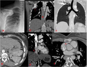 (a) Lung X-ray. A well-defined pleural-based calcified mass in the upper zone of the right lung. (b) Coronal CT section in mediastinal window. The mass is observed in soft tissue density with a calcified pleural base (red arrow). In addition, it is observed that the inferior vena cava continues in the thorax as the azygos vein (red asterisk). (c) Coronal MinIP image. Two hypoarterial main bronchi branching from the trachea are observed. (d) Polyplenism is observed in the left upper quadrant of the abdomen. (e) Opening of hepatic veins directly into the left atrium is observed. (f) Right atrial appendage is observed in left atrial appendage morphology (red asterisk).