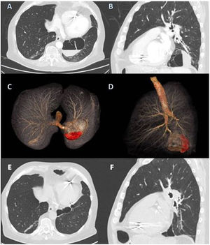 Multiplanar chest CT reconstructions with intravenous contrast in axial (A) and sagittal (B) planes where a bulla located in the medial basal segment of the LLL with hematic level is observed. 3D segmentation of the findings in axial (C) and sagittal (D) projection. In orange (C and D), the airway and bulla stand out, and bleeding is shown in red. Multiplanar CT reconstructions without intravenous contrast in axial (E) and sagittal (F) planes 5 months later. Persistence of the bulla located in the medial basal segment of LLL with smaller size and in the absence of the hematic level (E and F).
