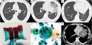 Chest computed tomography shows bilateral scattered ground-glass opacities with thickening of the interlobular septa (A–C, white arrows). Bloody bronchoalveolar lavage fluid (D); cytology shows hemosiderin-laden macrophages (E). Chest computed tomography shows an irregular mass in the left central lung (F, asterisk).