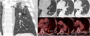 (A) Coronal CT image (lung window) shows 3 suspicious lung nodules in the superior segment of the left lower lobe. (B) Axial CT image (lung window) shows one solid nodule in the inferior region of the superior segment (arrow, lesion 1). (C) Axial CT image (lung window) shows one subpleural nodular opacity in the lateral aspect of the superior segment (arrow, lesion 2). (D) Axial CT image (lung window) shows one small solid nodule in the medial aspect of the superior segment (arrow, lesion 3). (E–G) Axial fused PET/CT images corresponding to lesions shown on Figs. B, C, and D, respectively.