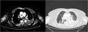 Chest CT. Left image: bilateral pleural effusion predominantly on the left side with secondary passive atelectasis. Right image: bilateral infiltrates.