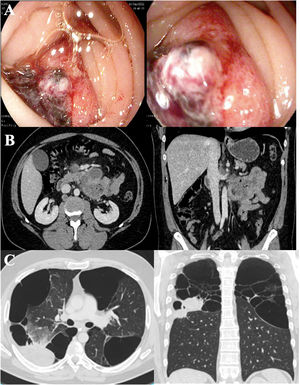 (A) Endoscopic image of a large duodenal ulcer with active oozing hemorrhage (Forrest IB). (B) Computed axial tomography image of the abdomen with lesion in the 4th segment of the duodenum with adjacent lymph node blockage. (C) Computed axial tomography image of the chest showing a tumor in the posterior segment of the right upper lung lobe. Extensive bulbous emphysema in upper lobes.