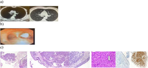Thorax computerized tomography of the patient. (a) Mediastinal and lung window. (b) Bronchoscopic view of the lesion. (c) Hematoxylin eosin sections 40× and 100×, tumoral infiltration in the submucosal forehead, 200×, mitotic cell is shown in the section marked with arrow, 400×, immunohistochemically low Ki67 index, 100×, vimentin positivity 3D.