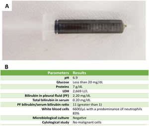 (A) Results of the study of pleural fluid obtained by thoracentesis.
