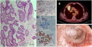 (A) Lesion composed of cords or sheets of basaloid odontogenic epithelial cells with peripheral palisading and reverse polarity surrounding nests of stellate reticulum-like cells. (H–E 10×, CD56 10×, ck19 10×, P40 10×). (B) PET-CT Showing central mass in the right upper lobe measuring 32mm×19mm with mediastinal spread. (C) Bronchoscopy finding of the image shown in B.