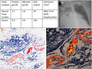 (A) Chest X-ray showing moderate to large right sided pleural effusion. (B, C) Pleural biopsy, Congo red stain in light (left) and polarized (right) microscope showing apple green birefringence consistent with amyloidosis.
