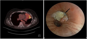 (A) hypemetabolic consolidation occupying the entire left upper lobe with obstruction of the upper lobe bronchus close to the bifurcation of the main bronchus; (B) flexible bronchoscopy shows an endobronchial lesion obstructing the left upper bronchus entrance (arrow).