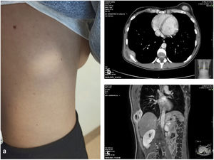 (a) Tumour in the right posteriolateral chest wall without evidence of inflammation. (b) Axial CT slice showing cystic-necrotic mass with extrapleural extension. (c) Coronal MRI image showing the same lesion with small septums inside.