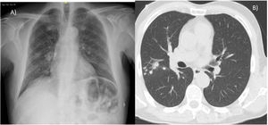 (A) Chest X-ray reveals a pseudonodular infiltrate in the right upper lobe (RUL). (B) Chest CT scan shows pulmonary nodule, in posterior segment of RUL contacting major fissure, with adjacent nodules and centrolobular pulmonary micronodules in RUL.