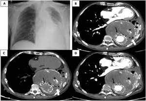 (A) Posteroanterior chest X-ray findings: mediastinal widening due to thoracic aortic aneurysm (TAA) with tracheal deviation to the right and a large retrocardiac opacity with significant volume loss of the left pulmonary base. (B) Contrast-enhanced thoracic computed tomography angiography (CTA) showed a TAA with aortic stent-graft (black-thin-arrow), a large aneurysmal sac (163mm×140mm (TxPA)) with a mural thrombus in it, an atherosclerotic plaque and irregular high attenuation areas within the aneurysmal sac suggesting calcium deposits (black star) similar to previous studies with no evidence of endoleaks and a left lung consolidation with atelectasis. Presence of air bubbles within the thrombosed aneurysm with a suspicious aortobronchopulmonary fistula lesion (white arrow). (C) Non-contrast CTA was useful to distinguish between endoleaks and calcifications within the aneurysmal sac. The high attenuation areas (black star) remained the same with the non-contrast and contrast-enhanced CTA suggesting calcifications. (D) 3 months earlier contrast-enhanced CTA to show the stability of the volume of the TAA, aneurysmal sac, calcifications and left lung atelectasis. No evidence of endoleaks or aortobronchopulmonary fistula.