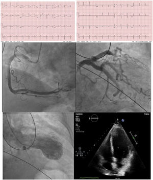 (a) ECG on the left performed with chest pain shows diffuse ST-segment elevation in I, II, avL and V1–V6, rectification in III and avF. ECG on the right performed after 2 months shows normalized leads. (b) Coronary angiogram on the left reveals the arteries without coronary disease. Left: right coronary artery. Right: left coronary artery. (c) Left ventriculography in systolic frame shows apical segment akinesis with a mild depressed LVEF (46%). (d) Echocardiography performed 2 months later shows a preserved contractibility with normalization of the LVEF (60%).