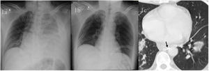 (a) Chest X-ray showing a left massive pleural effusion, pneumomediastinum and neck subcutaneous emphysema. (b) Postoperative chest X-ray, 24h after right VATS for clipping the thoracic duct. (c) Chest CT showing disseminated lung septic emboli. A metallic clip can be detected (black arrow), at T9 level, between the aorta and the azygos vein.