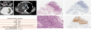 (1.1) Chest computed tomography images. (A and B) Mediastinal window. (C) Parenchymatous window. Massive right pleural effusion (white arrows) associated with focal pleural thickening (red arrows), mediastinal structures shifted to the left (yellow arrow), and right paratracheal mediastinal lymph nodes (blue arrow) are observed. (1.2) Results of the study of pleural fluid obtained by thoracentesis. (1.3) Panoramic image of pleural tumor infiltration (H–E 20×). (B) Detail of medium-sized plasmacytoid cell types and lateralized basophil nuclei, occasional nucleoles, and scant or moderate cytoplasms arranged in threads, strings or diffusely (H–E 40×). (C) Absence of epithelial marker expression (CK AE1-3 10×). (D) Intense diffuse cytoplasmic expression to melanocytic markers (HMB-45 10×).