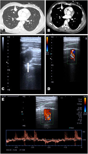 Lung CT revealed a dilated vascular structure in the right middle lobe close to the pleura (A and B, white arrow), compatible with PAVM. Pulmonary echography showed a right parasternal hypoechoic image with an intraluminal hyperechoic area, compatible with thrombosis (C, white arrow). Doppler mode revealed a ‘mosaic-pattern’ indicative of mixing of arterial and venous blood consistent with PAVMs (D). Here, the anterograde and retrograde flow form a “ying-yang sign” (asterisk). Pulsed doppler image demonstrated arterial and venous flows (E).