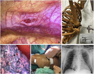 (a) Parietal pleural lesion corresponding to the trocar entry point. (b) Simulation of the patient