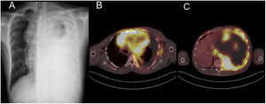 (A) Chest X-ray image showing unilateral white hemithorax associated with massive pleural effusion causing contralateral displacement and an anterior mediastinal mass. (B, C) PET-CT: Large heterogeneous lymph node cluster in prevascular mediastinal fatty space, with areas of hypometabolism and necrosis and other hypermetabolic regions consistent with malignancy, displacing mediastinal structures to the right and engulfing the large vessels. Significant for marked left pleuropulmonary thickening, measuring up to 6cm in the paracardiac region, with intense pathological metabolic activity.