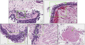 Examples of bronchial biopsies showing: (A) Eosinophilic infiltration of the submucosa (square); (B) Goblet cells hyperplasia (arrow); (C) Squamous metaplasia (square); (D) Thickness of the basement membrane (arrow); (E) Smooth muscle hypertrophy (arrow).