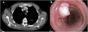 (A) Thoracic computorized tomography in axial plane demonstrating a polypoid lesion in the left side of the middle third of the trachea, with a maximum diameter of 12mm. (B) Endotracheal view of the trachea, confirming the presence of a vascularized polypoid lesion in the left wall of the middle third of the trachea.
