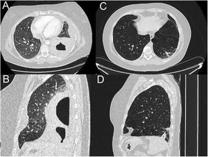 CT pulmonary angiogram. Extensive consolidation that occupies the entire left lower lobe with two cavitations inside with air-fluid level, the largest of 7cm, suggesting necrotizing pneumonia with lung abscesses (A and B). Complete resolution of the pneumonic process visualizing in its place an area with fibro-atelectatic changes as a residual finding (C and D).