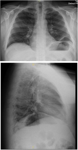 Chest X-ray (Oct 2018) revealing ascension of both hemi diaphragms with retracted lungs associated with bilateral basal atelectasis.