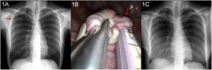 (A) Chest X-ray showing the presence of a right apical pneumothorax (red arrow). (B) Intraoperative image: Dystrophic/bullous complex observed in the right apical lung parenchyma (red arrow) and the stapler used for its surgical resection. (C) Postoperative follow-up chest X-ray shows no evidence of complications.